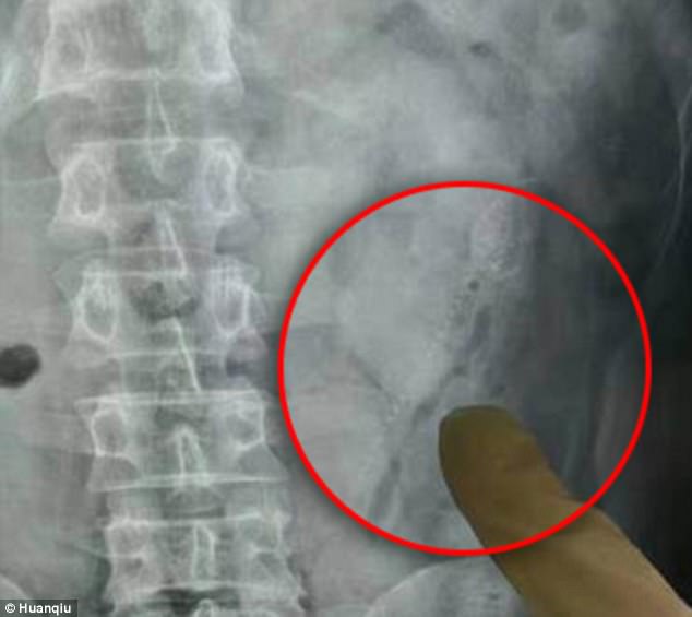 Shocking: Doctors said one of the pond loaches broke through the intestinal wall