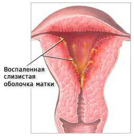 Эндометрит или воспаление матки